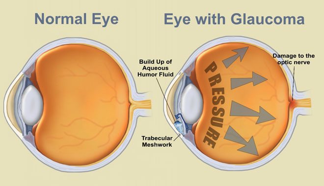 glaucoma_UP