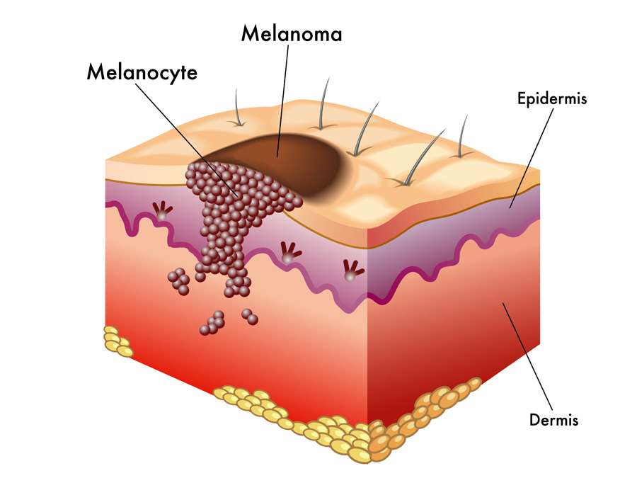 melanoma_in