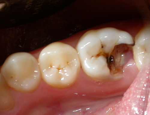 Τα αποφρακτικά υλικά οπών και σχισμών προστατεύουν τα δόντια και λειτουργούν προληπτικά κατά της τερηδόνας