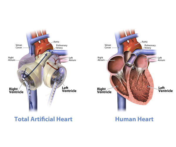 Τεχνητή καρδιά: τέλος στις μεταμοσχεύσεις τα επόμενα χρόνια;