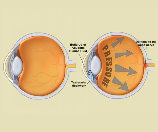 Γλαύκωμα: η έγκαιρη διάγνωση σώζει την όραση