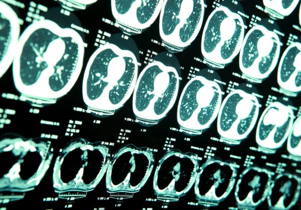 MRI of human brain
