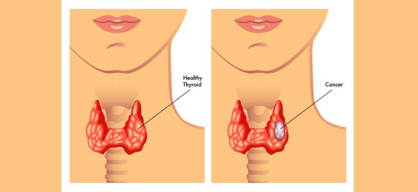 thyroid cancer_UP