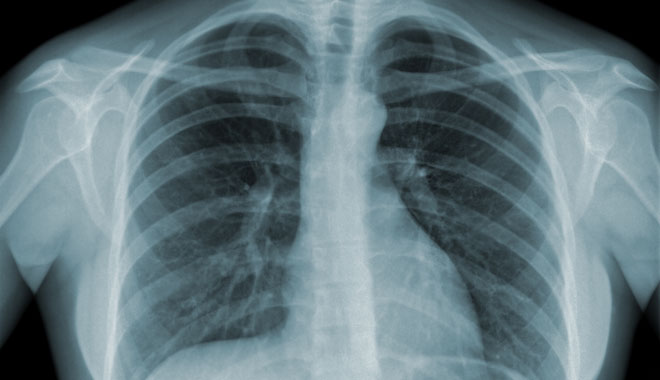 Detail of an x-ray of lungs on black background