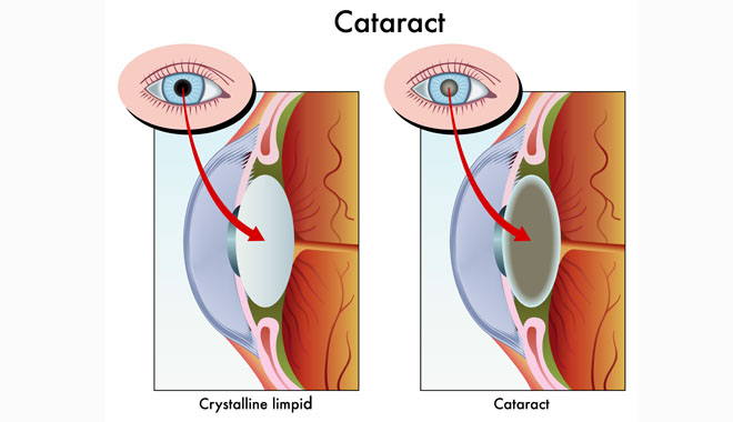 cataract-2-up
