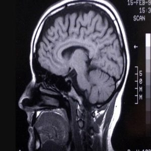 Η παθοφυσιολογία του εγκεφαλικού θανάτου και η διαδικασία διαπιστώσεώς του